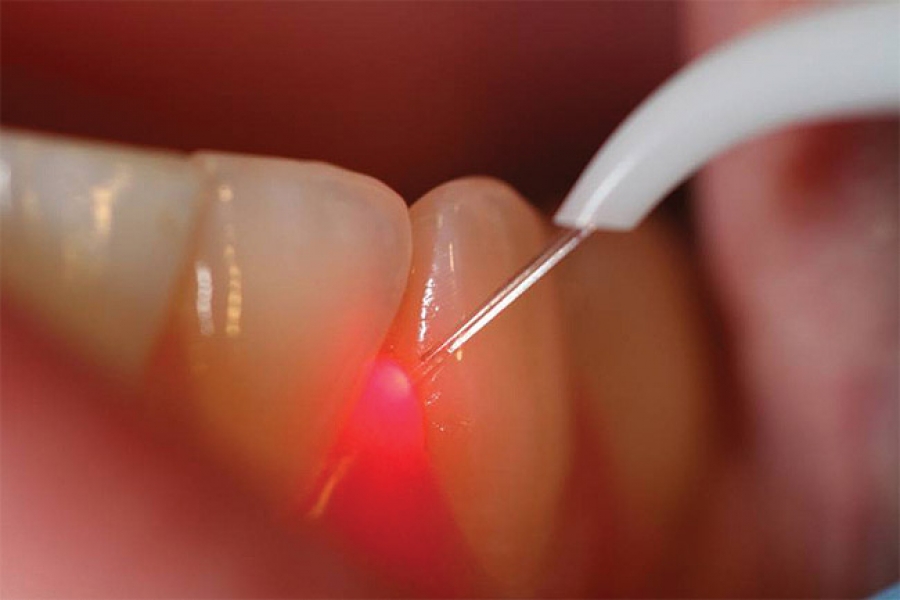 laser odontoiatrico